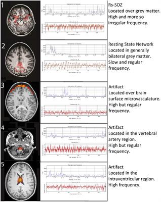 Treatable brain network biomarkers in children in coma using task and resting-state functional MRI: a case series